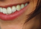 Como Branquear os Dentes